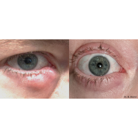 ENVISION платформа для нехірургічного лікування причин сухого ока від InMode ENVISION платформа для нехірургічного лікування причин сухого ока від InMode