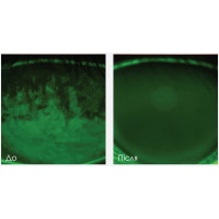 ENVISION платформа для нехірургічного лікування причин сухого ока від InMode ENVISION платформа для нехірургічного лікування причин сухого ока від InMode