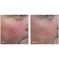 ENVISION платформа для нехірургічного лікування причин сухого ока від InMode ENVISION платформа для нехірургічного лікування причин сухого ока від InMode