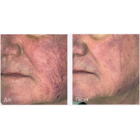 ENVISION платформа для нехірургічного лікування причин сухого ока від InMode ENVISION платформа для нехірургічного лікування причин сухого ока від InMode