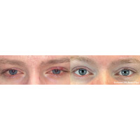 ENVISION платформа для нехірургічного лікування причин сухого ока від InMode ENVISION платформа для нехірургічного лікування причин сухого ока від InMode