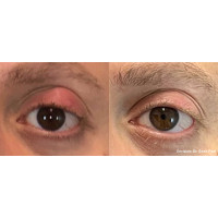 ENVISION платформа для нехірургічного лікування причин сухого ока від InMode ENVISION платформа для нехірургічного лікування причин сухого ока від InMode