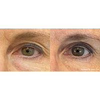 ENVISION платформа для нехірургічного лікування причин сухого ока від InMode ENVISION платформа для нехірургічного лікування причин сухого ока від InMode