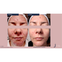 Апарат Jet Peel Jet Pro для безін'єкційної мезотерапії та оксигенотерапії від ТavTech