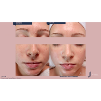 Апарат Jet Peel Jet Pro для безін'єкційної мезотерапії та оксигенотерапії від ТavTech