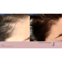 Апарат Jet Peel Jet Pro для безін'єкційної мезотерапії та оксигенотерапії від ТavTech