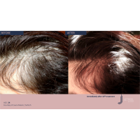 Апарат Jet Peel Jet Pro для безін'єкційної мезотерапії та оксигенотерапії від ТavTech