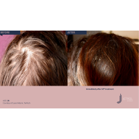 Апарат Jet Peel Jet Pro для безін'єкційної мезотерапії та оксигенотерапії від ТavTech