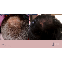 Апарат Jet Peel Jet Pro для безін'єкційної мезотерапії та оксигенотерапії від ТavTech