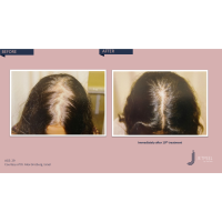 Апарат Jet Peel Jet Pro для безін'єкційної мезотерапії та оксигенотерапії від ТavTech