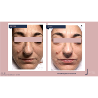 Апарат Jet Peel Jet Pro для безін'єкційної мезотерапії та оксигенотерапії від ТavTech