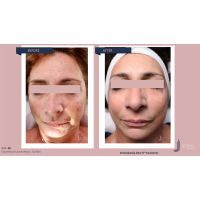 Апарат Jet Peel Jet Pro для безін'єкційної мезотерапії та оксигенотерапії від ТavTech