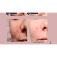 Апарат Jet Peel Jet Pro для безін'єкційної мезотерапії та оксигенотерапії від ТavTech