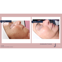 Апарат Jet Peel Jet Pro для безін'єкційної мезотерапії та оксигенотерапії від ТavTech