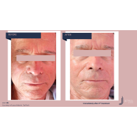 Апарат Jet Peel Jet Pro для безін'єкційної мезотерапії та оксигенотерапії від ТavTech