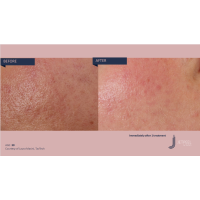 Апарат Jet Peel Jet Pro для безін'єкційної мезотерапії та оксигенотерапії від ТavTech