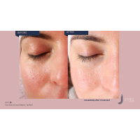 Апарат Jet Peel Jet Pro для безін'єкційної мезотерапії та оксигенотерапії від ТavTech