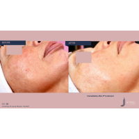 Апарат Jet Peel Jet Pro для безін'єкційної мезотерапії та оксигенотерапії від ТavTech