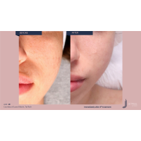 Апарат Jet Peel Jet Pro для безін'єкційної мезотерапії та оксигенотерапії від ТavTech