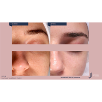 Апарат Jet Peel Jet Pro для безін'єкційної мезотерапії та оксигенотерапії від ТavTech