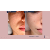 Апарат Jet Peel Jet Pro для безін'єкційної мезотерапії та оксигенотерапії від ТavTech