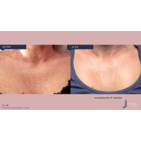 Апарат Jet Peel Jet Pro для безін'єкційної мезотерапії та оксигенотерапії від ТavTech