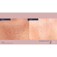 Апарат Jet Peel Jet Pro для безін'єкційної мезотерапії та оксигенотерапії від ТavTech