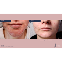 Апарат Jet Peel Jet Pro для безін'єкційної мезотерапії та оксигенотерапії від ТavTech