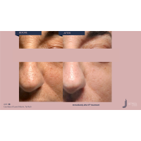 Апарат Jet Peel Jet Pro для безін'єкційної мезотерапії та оксигенотерапії від ТavTech