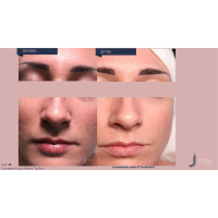 Апарат Jet Peel Jet Pro для безін'єкційної мезотерапії та оксигенотерапії від ТavTech