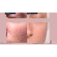 Апарат Jet Peel Jet Pro для безін'єкційної мезотерапії та оксигенотерапії від ТavTech