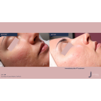 Апарат Jet Peel Jet Pro для безін'єкційної мезотерапії та оксигенотерапії від ТavTech