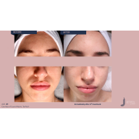 Апарат Jet Peel Jet Pro для безін'єкційної мезотерапії та оксигенотерапії від ТavTech