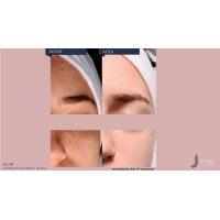 Апарат Jet Peel Jet Pro для безін'єкційної мезотерапії та оксигенотерапії від ТavTech