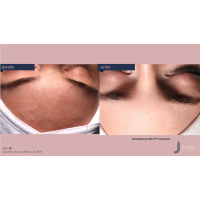 Апарат Jet Peel Jet Pro для безін'єкційної мезотерапії та оксигенотерапії від ТavTech