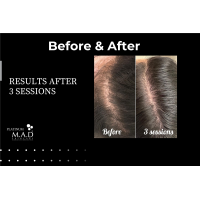 Сироватка для росту волосся Анаген / SYNPLA Anagen Growth Factor Serum - 5 pack
