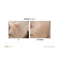 Venus Versa універсальна багатофункціональна платформа для неінвазивних естетичних процедур від Venus Concept