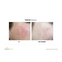 Venus Versa універсальна багатофункціональна платформа для неінвазивних естетичних процедур від Venus Concept