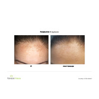 Venus Versa універсальна багатофункціональна платформа для неінвазивних естетичних процедур від Venus Concept