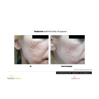 Venus Versa універсальна багатофункціональна платформа для неінвазивних естетичних процедур від Venus Concept