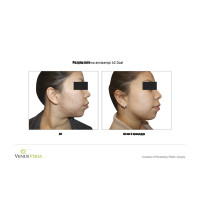 Venus Versa універсальна багатофункціональна платформа для неінвазивних естетичних процедур від Venus Concept