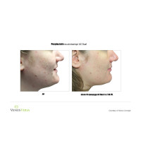 Venus Versa універсальна багатофункціональна платформа для неінвазивних естетичних процедур від Venus Concept