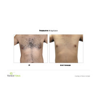 Venus Versa універсальна багатофункціональна платформа для неінвазивних естетичних процедур від Venus Concept