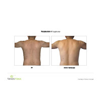 Venus Versa універсальна багатофункціональна платформа для неінвазивних естетичних процедур від Venus Concept