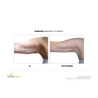 Venus Versa універсальна багатофункціональна платформа для неінвазивних естетичних процедур від Venus Concept