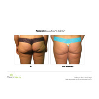 Venus Versa універсальна багатофункціональна платформа для неінвазивних естетичних процедур від Venus Concept