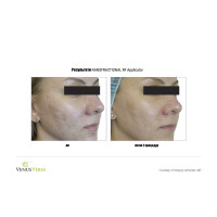 Venus Versa універсальна багатофункціональна платформа для неінвазивних естетичних процедур від Venus Concept