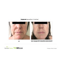 Venus Versa універсальна багатофункціональна платформа для неінвазивних естетичних процедур від Venus Concept