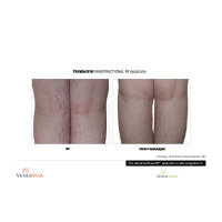 Venus Versa універсальна багатофункціональна платформа для неінвазивних естетичних процедур від Venus Concept