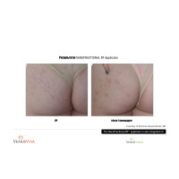 Venus Versa універсальна багатофункціональна платформа для неінвазивних естетичних процедур від Venus Concept